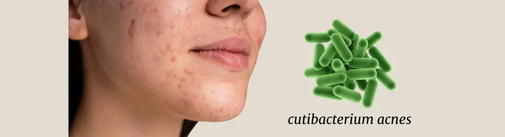 Alcohol and acne