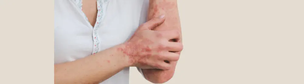 Alcohol effects on skin