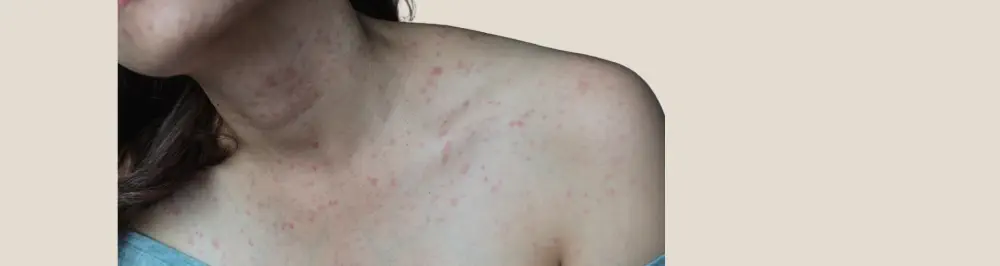 Alcoholic skin sores