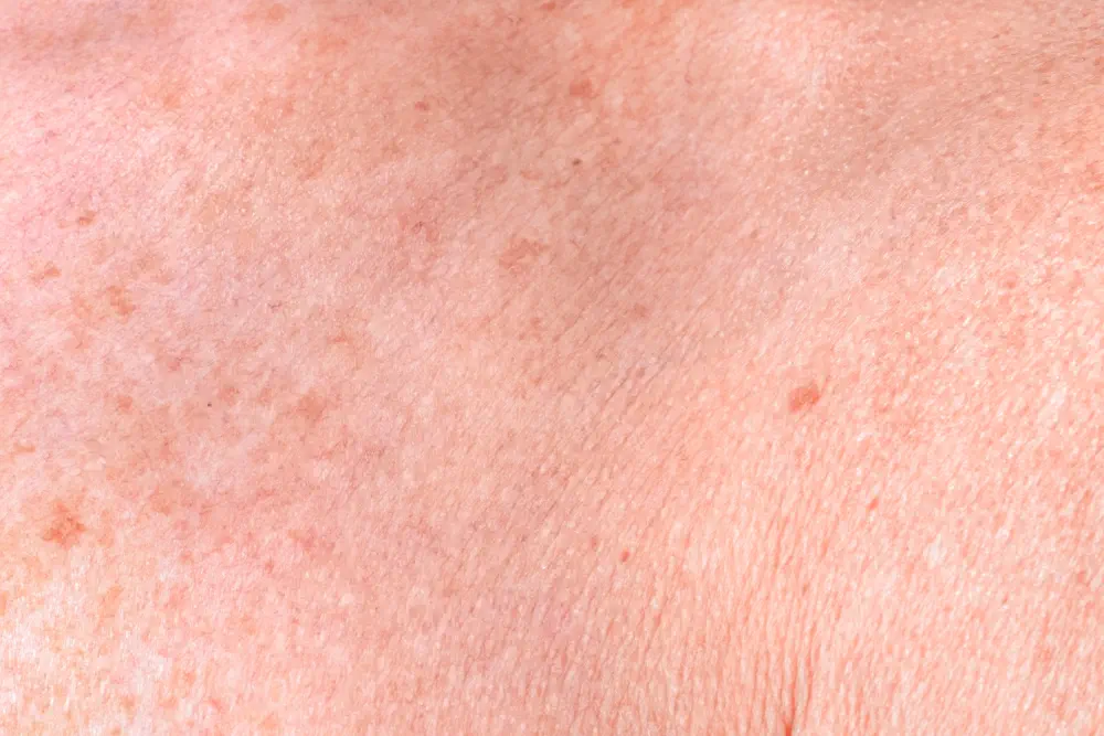Signs of alcoholism skin