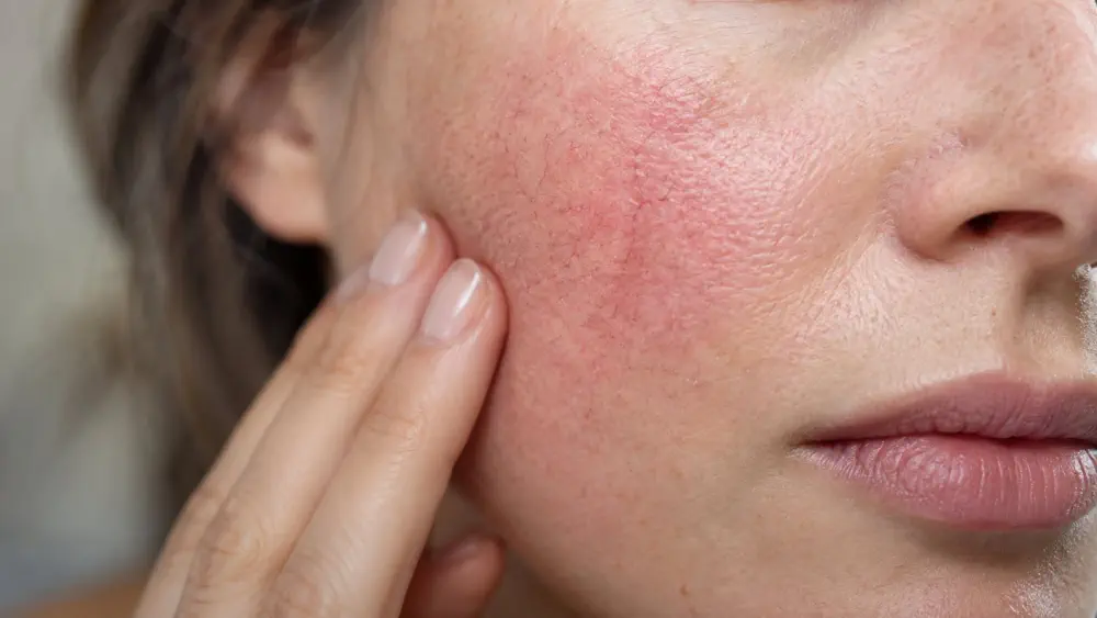 Red face after alcohol